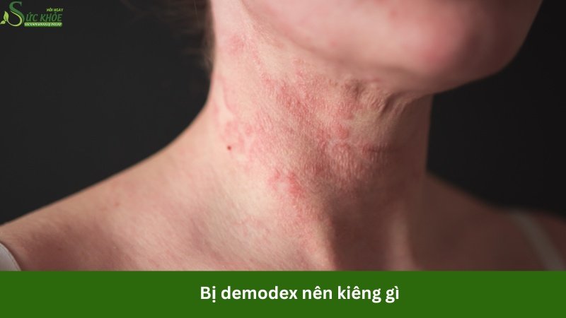 bi-demodex-nen-kieng-gi-4234